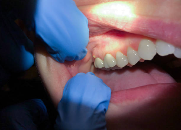 Best Emergency Treatment for Dental Infections or Abscesses in Montgomery, PA