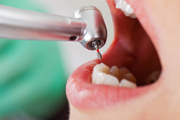 Best Urgent Care for Lost Fillings or Crowns in Montgomery, PA